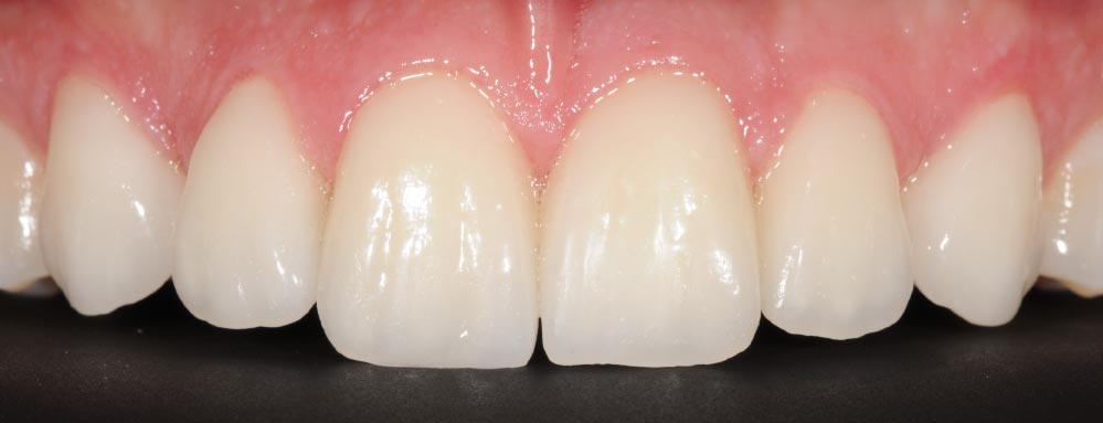 materiali delle faccette dentali - Caso clinico dopo 