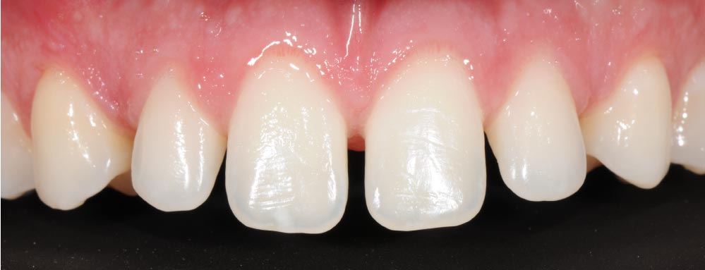 materiali delle faccette dentali - caso clinico prima 