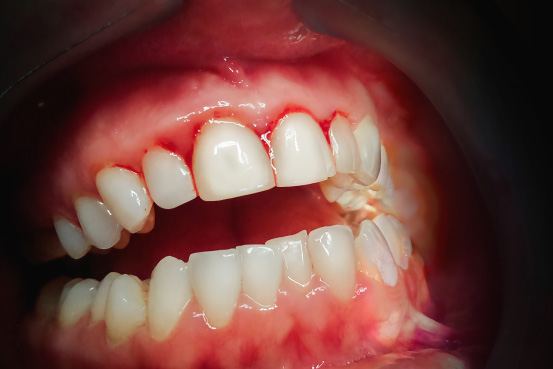 sintomi della parodontite 1